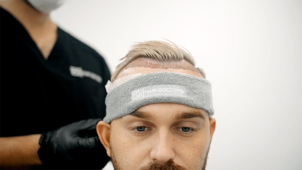 چرا در مورد ورزش بعد از کاشت مو باید محتاط باشیم؟