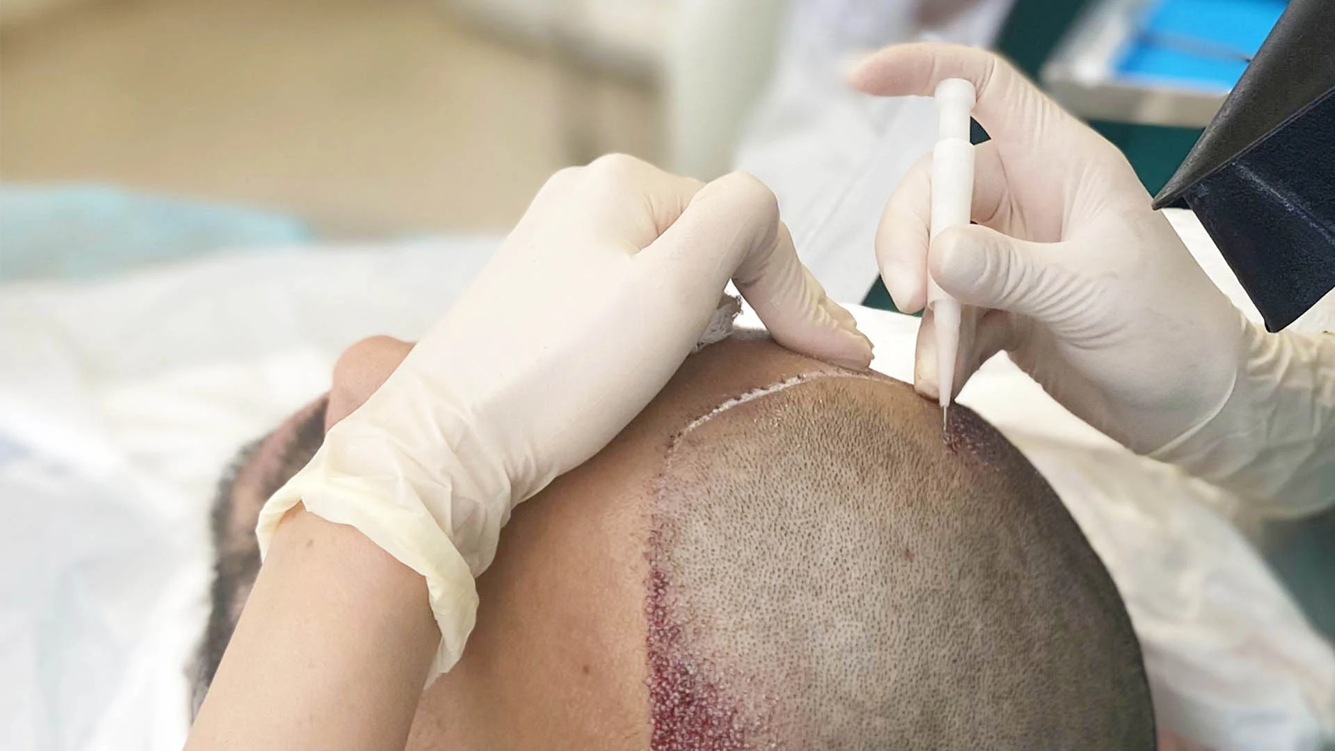 چرا انتخاب بهترین کلینیک کاشت مو اهمیت دارد؟