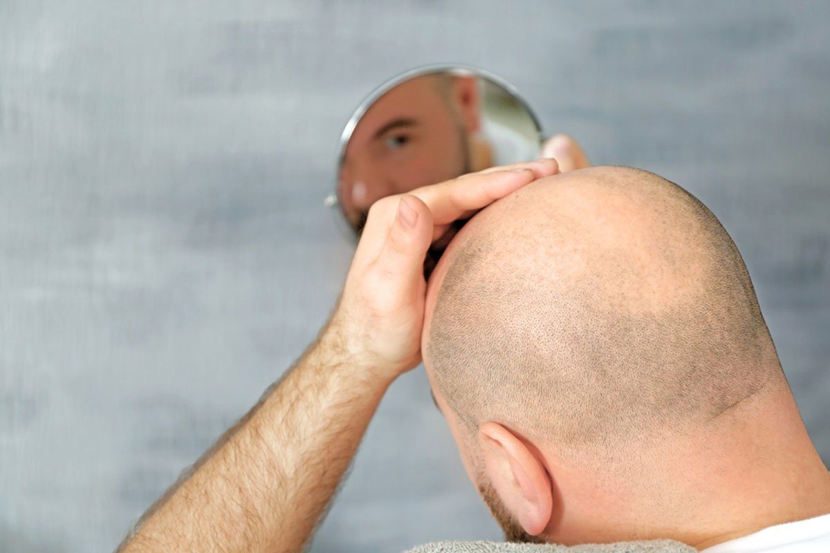 ویژگی‌های طبیعی‌ترین خط رویش مو چیست؟