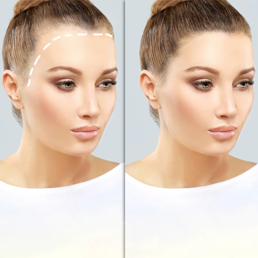 آیا کاشت مو برای خانم‌ها امکان‌پذیر است؟