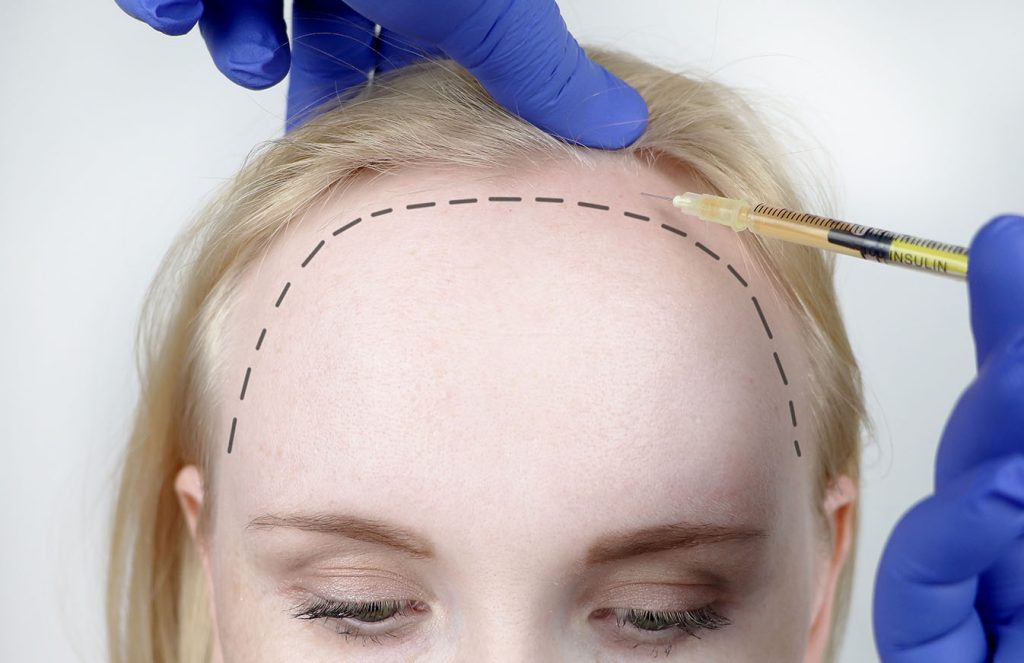 چه کسانی بیشتر دچار شوک ریزش می‌شوند؟