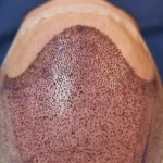 خونریزی بعد از کاشت مو