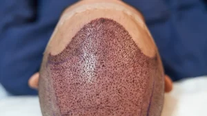 خونریزی بعد از کاشت مو