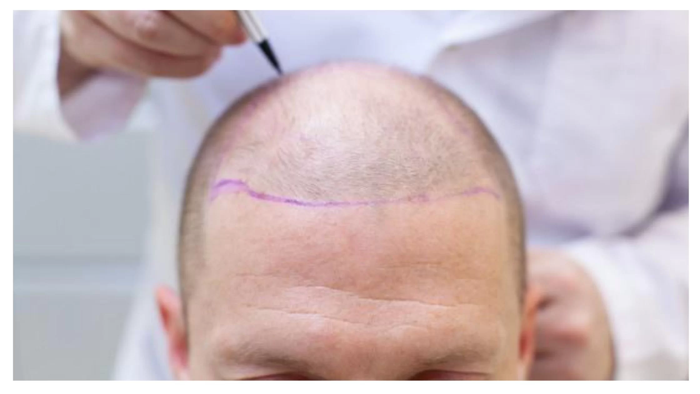 سوالات متداول درباره انتخاب بهترین دکتر کاشت مو