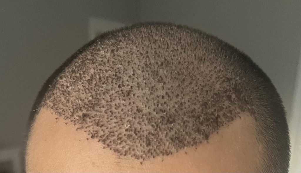 خارش بعد از کاشت مو