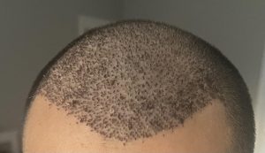 خارش بعد از کاشت مو