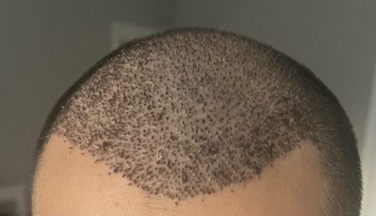 خارش بعد از کاشت مو