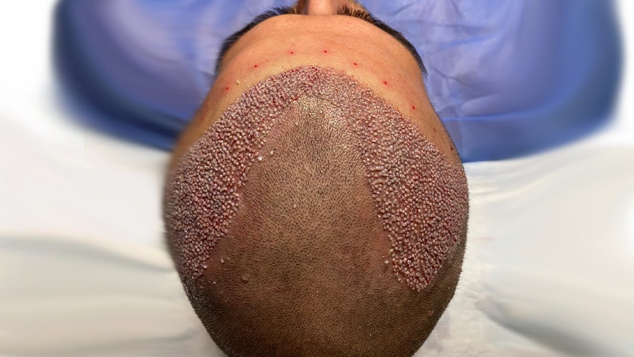 عفونت بعد از کاشت مو چیست و چرا اتفاق می‌افتد