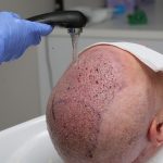 عفونت بعد از کاشت مو