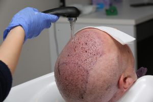 عفونت بعد از کاشت مو