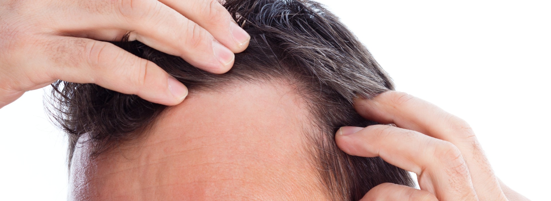 آیا کاشت شقیقه‌ها برای همه مناسب است؟