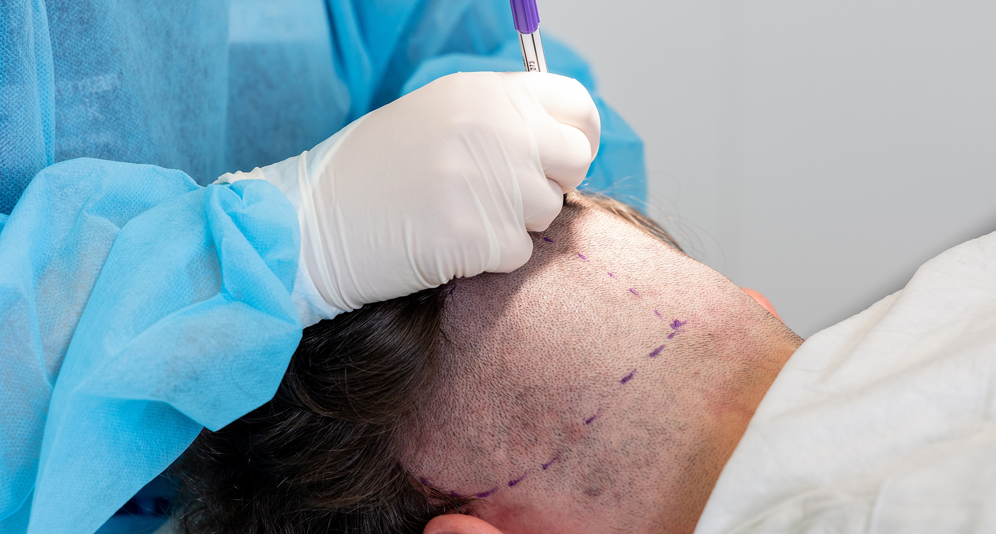 روغن‌تراپی بعد از کاشت مو چرا مهم است