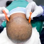 کاشت مو به روش Micro FIT