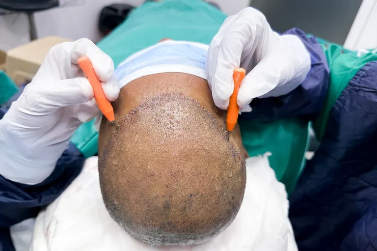 کاشت مو به روش Micro FIT