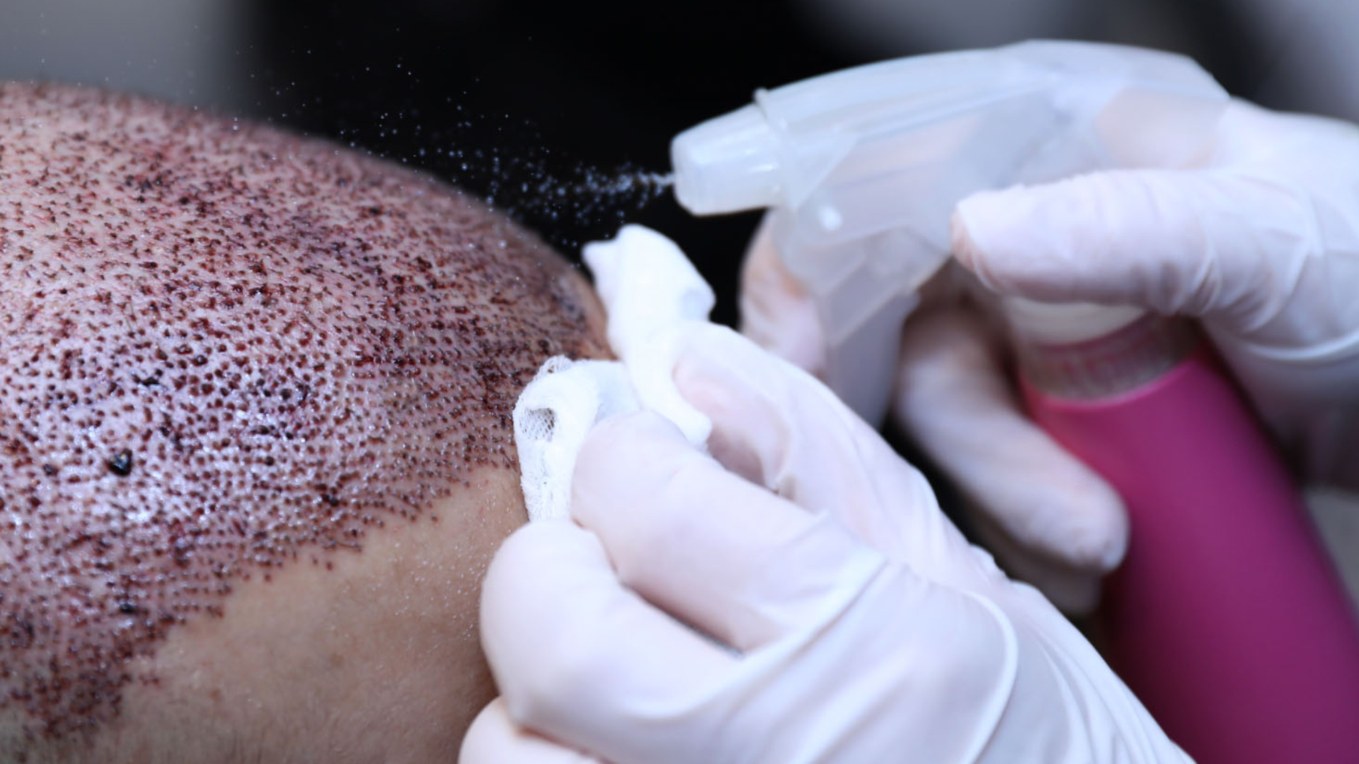 نکات مهم قبل و بعد از رنگ مو بعد از کاشت مو