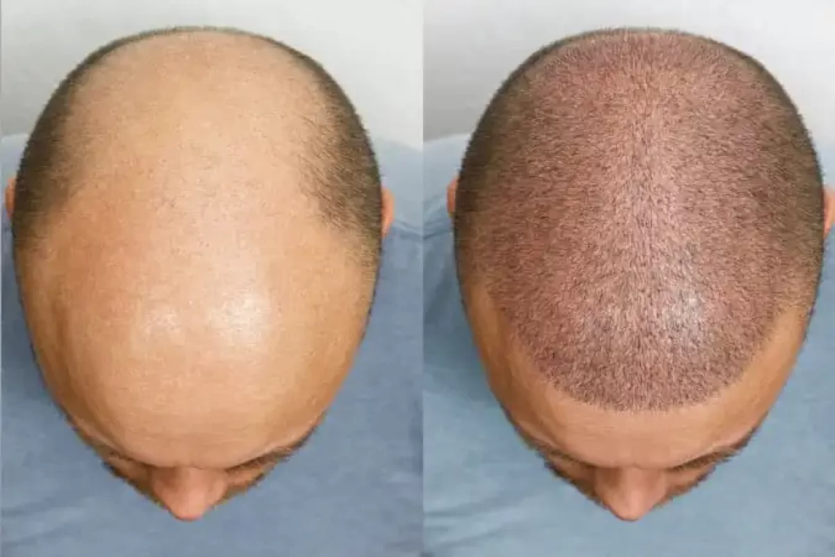 درد بعد از کاشت مو طبیعی است