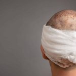 درد بعد از کاشت مو